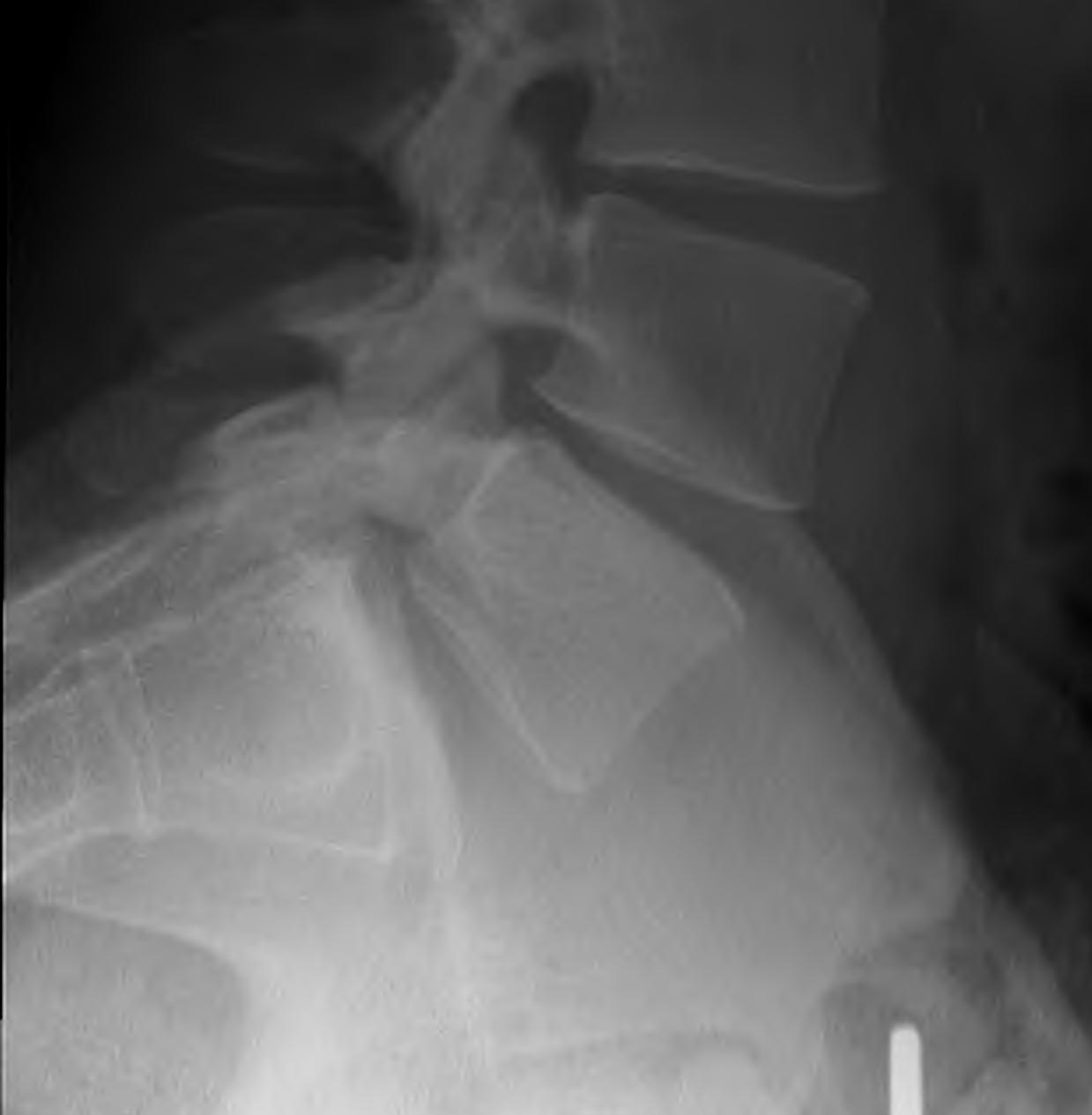 Lytic Pars Grade 1 Spondylolithesis